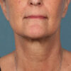 Kybella case #4629