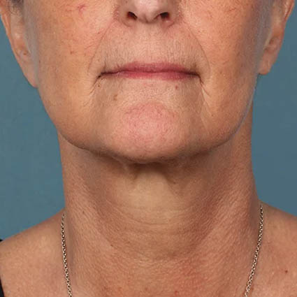 Kybella case #4629