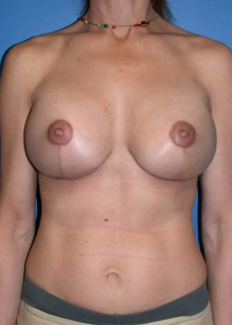 Breast Augmentation with Full Lift case #3919
