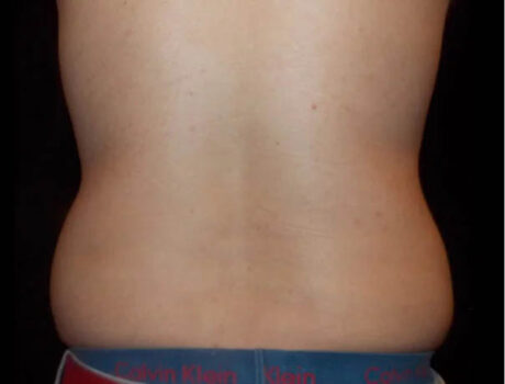 Coolsculpting case #4304