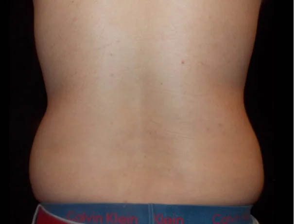 Coolsculpting case #4304