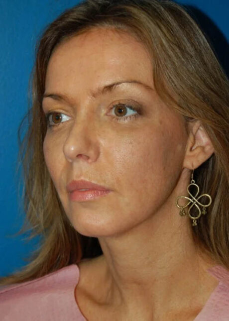 Chin Implant case #4183