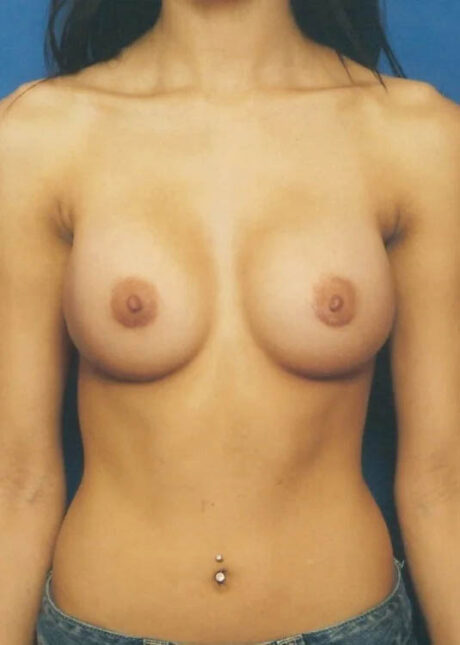 Breast Augmentation case #3625