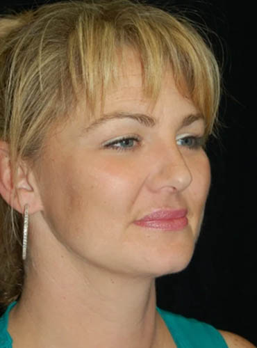 Buccal Fat Removal case #4111