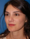 Facial Fat Grafting case #4487
