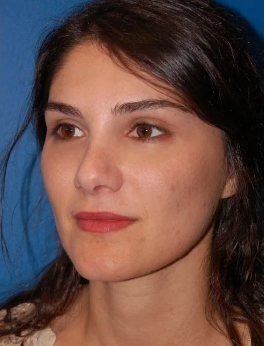 Facial Fat Grafting case #4487