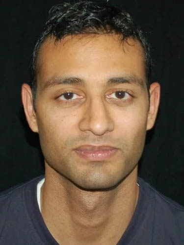 Otoplasty case #5020
