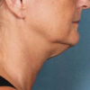 Kybella case #4629