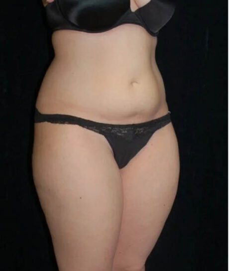 Liposuction case #4671