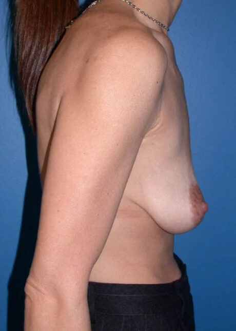 Breast Augmentation with Full Lift case #3919
