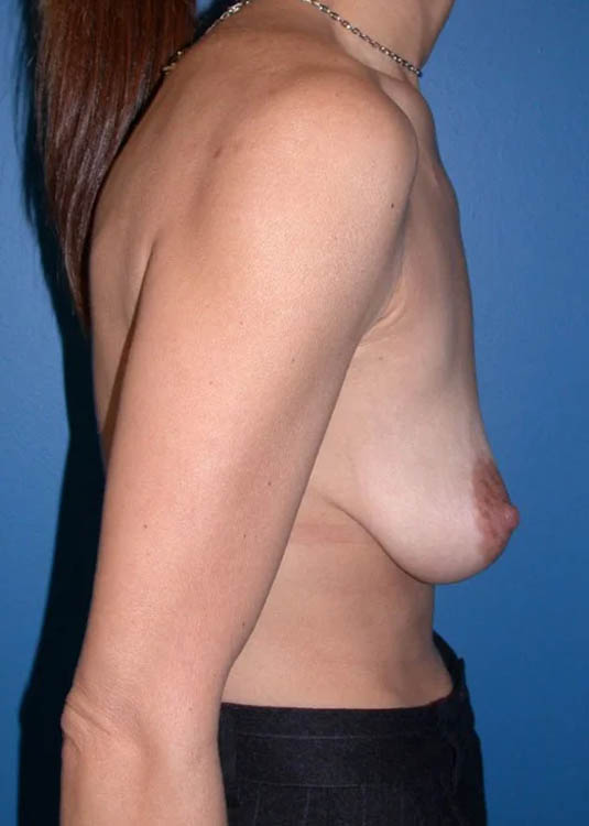 Breast Augmentation with Full Lift case #3919