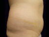 Coolsculpting case #4304