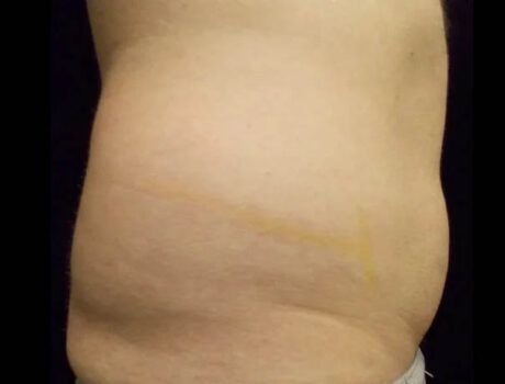 Coolsculpting case #4304