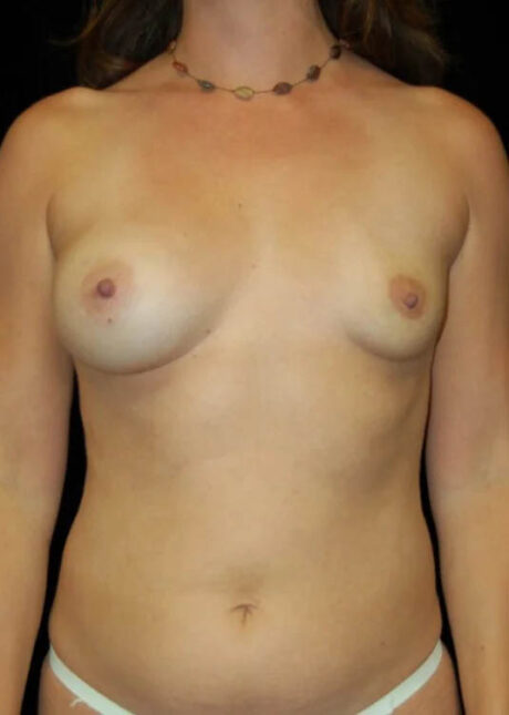 Breast Implant Revision case #3820