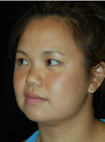 Buccal Fat Removal case #4114