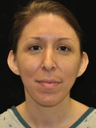 Otoplasty case #5023