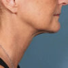 Kybella case #4629