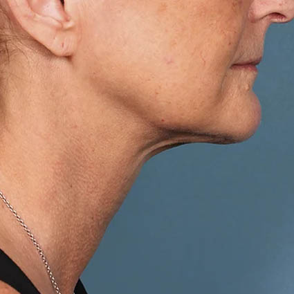 Kybella case #4629