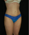 Liposuction case #4671