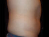 Coolsculpting case #4304
