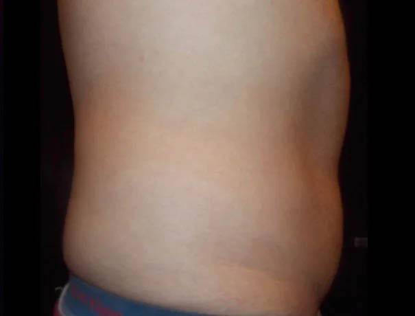Coolsculpting case #4304