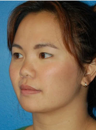 Buccal Fat Removal case #4114