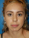 Facial Fat Grafting case #4492