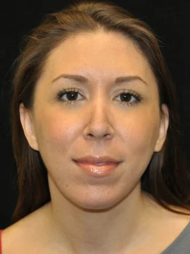 Otoplasty case #5023