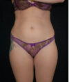 Liposuction case #4678