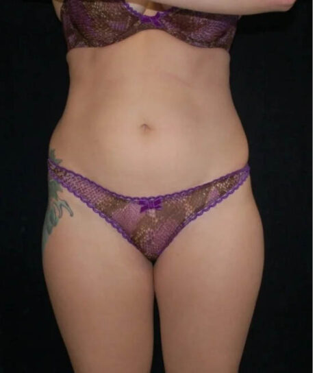 Liposuction case #4678