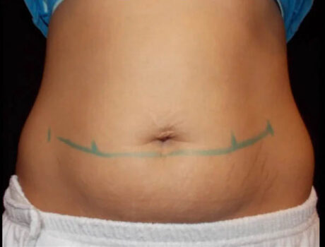 Coolsculpting case #4309