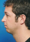 Chin Implant case #4186