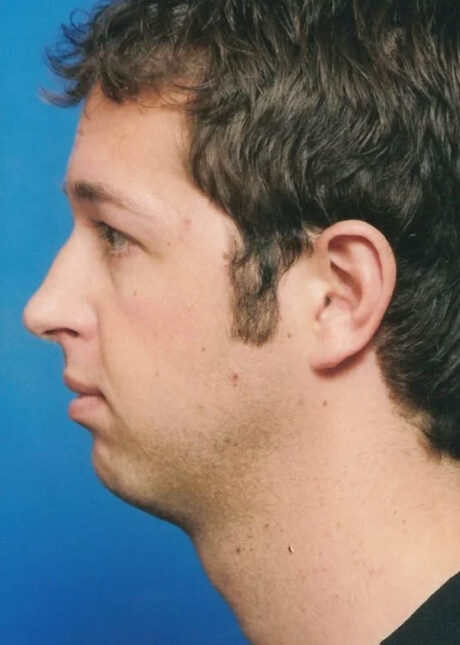 Chin Implant case #4186