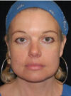 Buccal Fat Removal case #4117