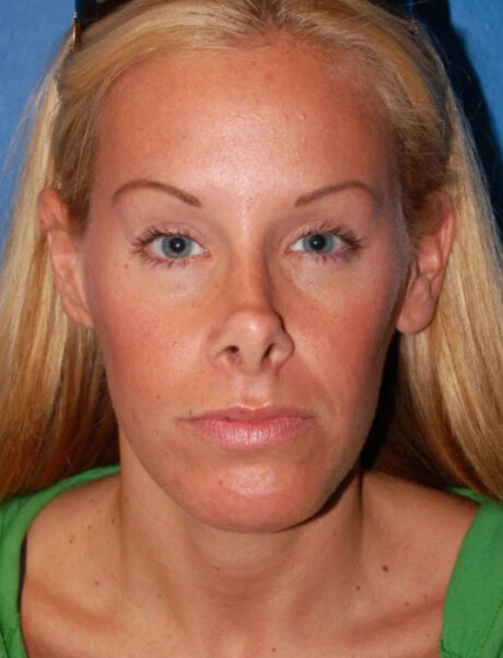 Facial Fat Grafting case #4495