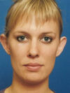 Otoplasty case #5026