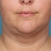 Kybella case #4634