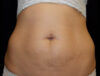 Coolsculpting case #4309