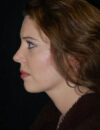 Neck Liposuction case #4938
