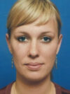 Otoplasty case #5026