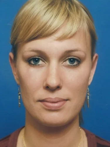 Otoplasty case #5026