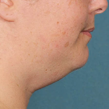 Kybella case #4634
