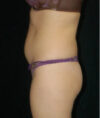 Liposuction case #4678