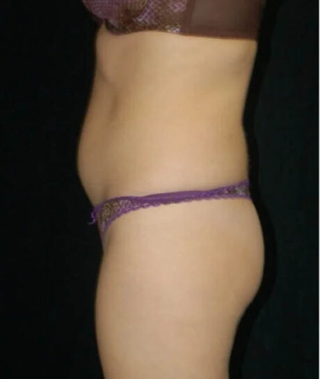 Liposuction case #4678