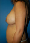 Revision Breast Augmentation with Benelli Lift case #3890