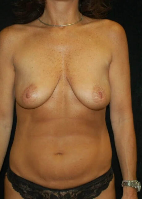 Breast Augmentation with Full Lift case #3926