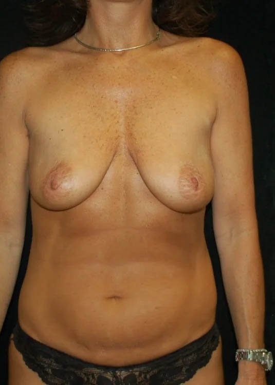 Breast Augmentation with Full Lift case #3926