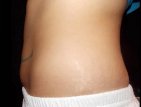 Coolsculpting case #4309