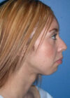 Chin Implant case #4193