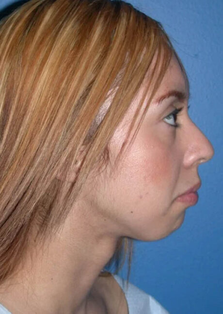 Chin Implant case #4193